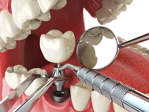 Best Emergency Root Canal Treatment in Lexington, MO